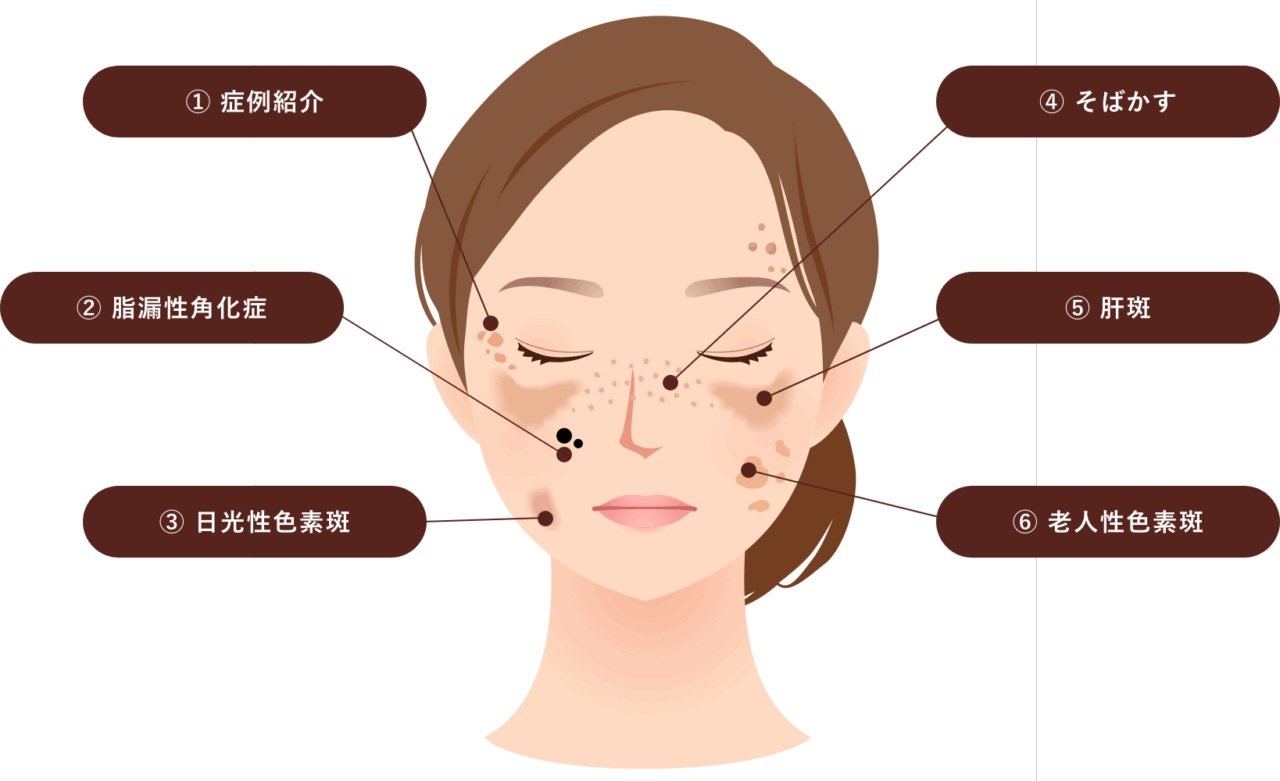 「富山県高岡市・射水市氷見市でシミ取り治療を提供している形成外科・皮膚科・美容皮膚科のだいぞうクリニック、シミの種類イメージ図」
